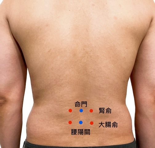 長期腰酸背痛 中醫針刀有「解」