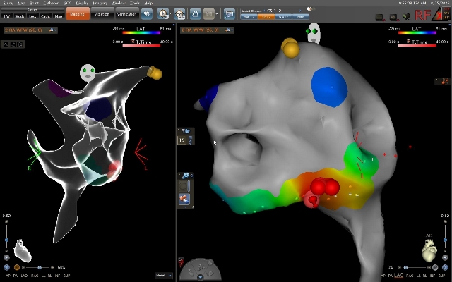 透過3D電生理定位系統，醫師能在立體模型中清楚辨識正常傳導路徑（黃點處）與副傳導路